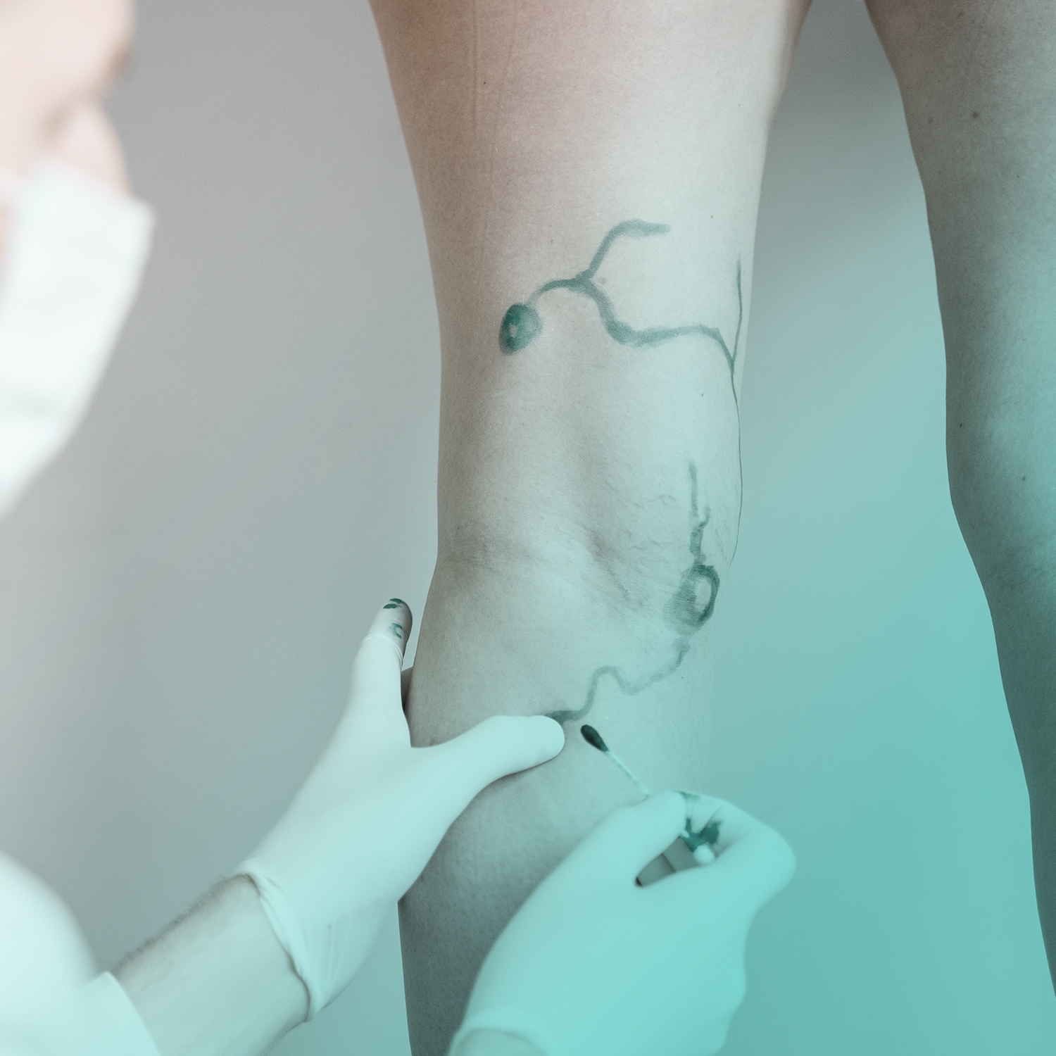 CHIRURGIA VASCOLARE al J|medical